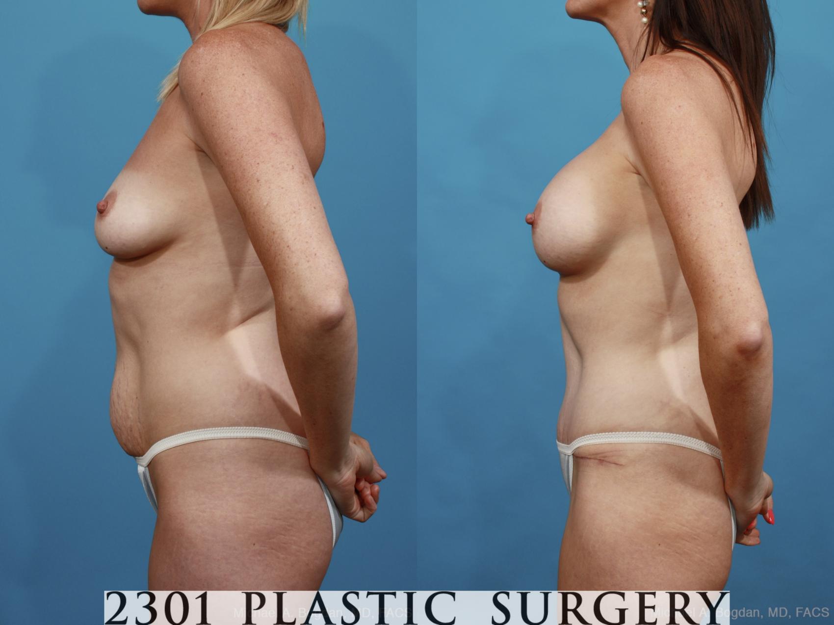 Before & After Mommy Makeover Case 443 View #3 View in Fort Worth & Frisco, Texas