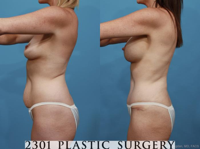 Before & After Mommy Makeover Case 443 View #4 View in Fort Worth & Frisco, Texas