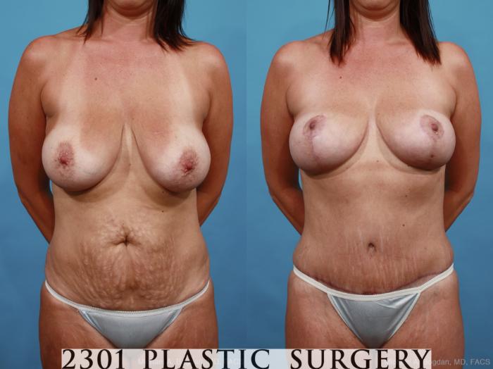 Before & After Mommy Makeover Case 452 View #1 View in Fort Worth, Plano, & Frisco, Texas