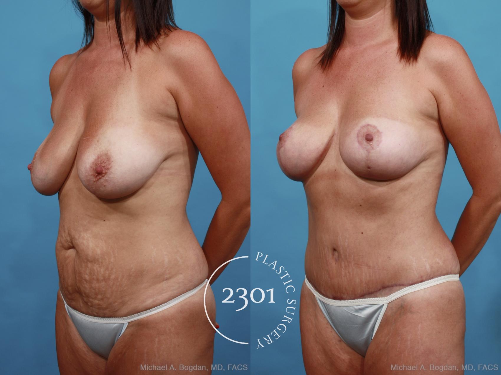 Before & After Mommy Makeover Case 452 View #2 View in Fort Worth, Plano, & Frisco, Texas