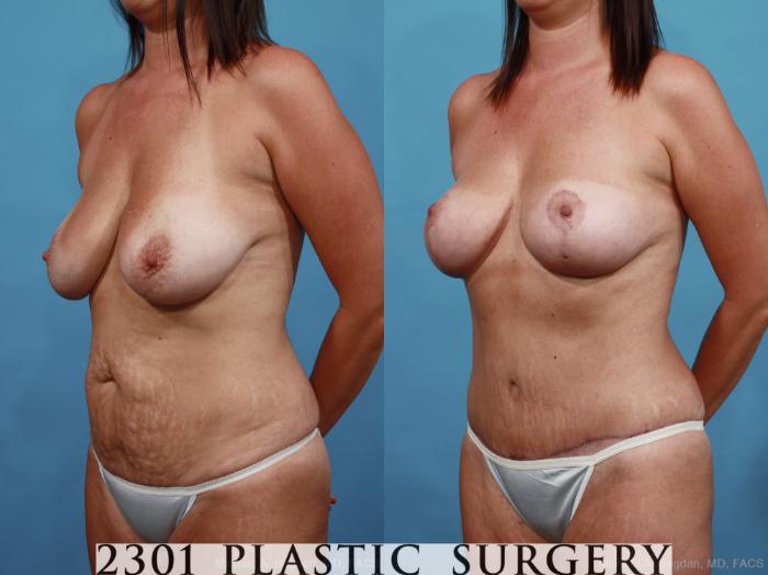 Before & After Mommy Makeover Case 452 View #2 View in Fort Worth, Plano, & Frisco, Texas