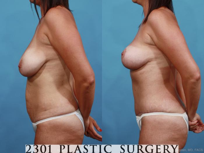 Before & After Mommy Makeover Case 452 View #3 View in Fort Worth, Plano, & Frisco, Texas