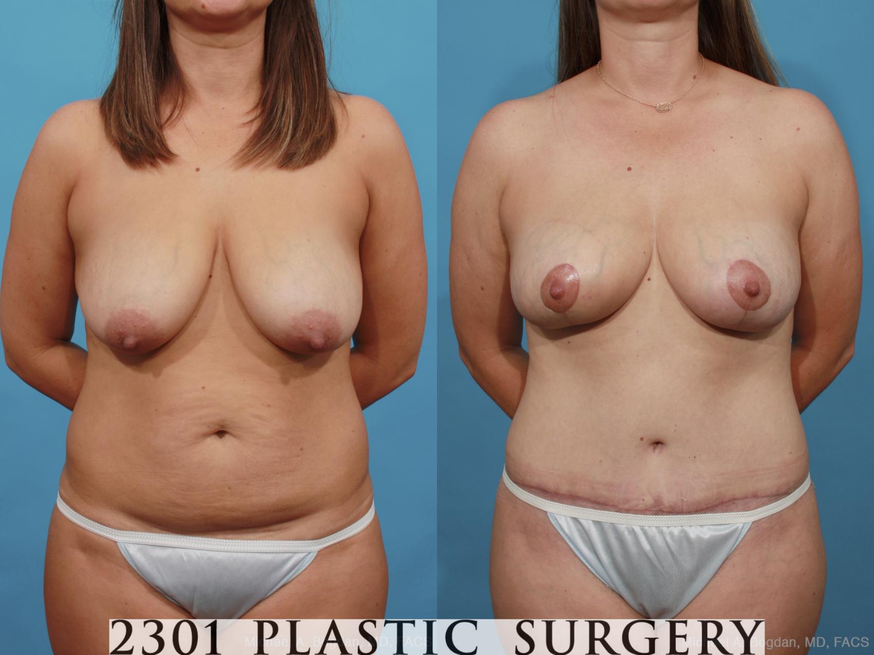 Before & After Mommy Makeover Case 454 View #1 View in Fort Worth, Plano, & Frisco, Texas