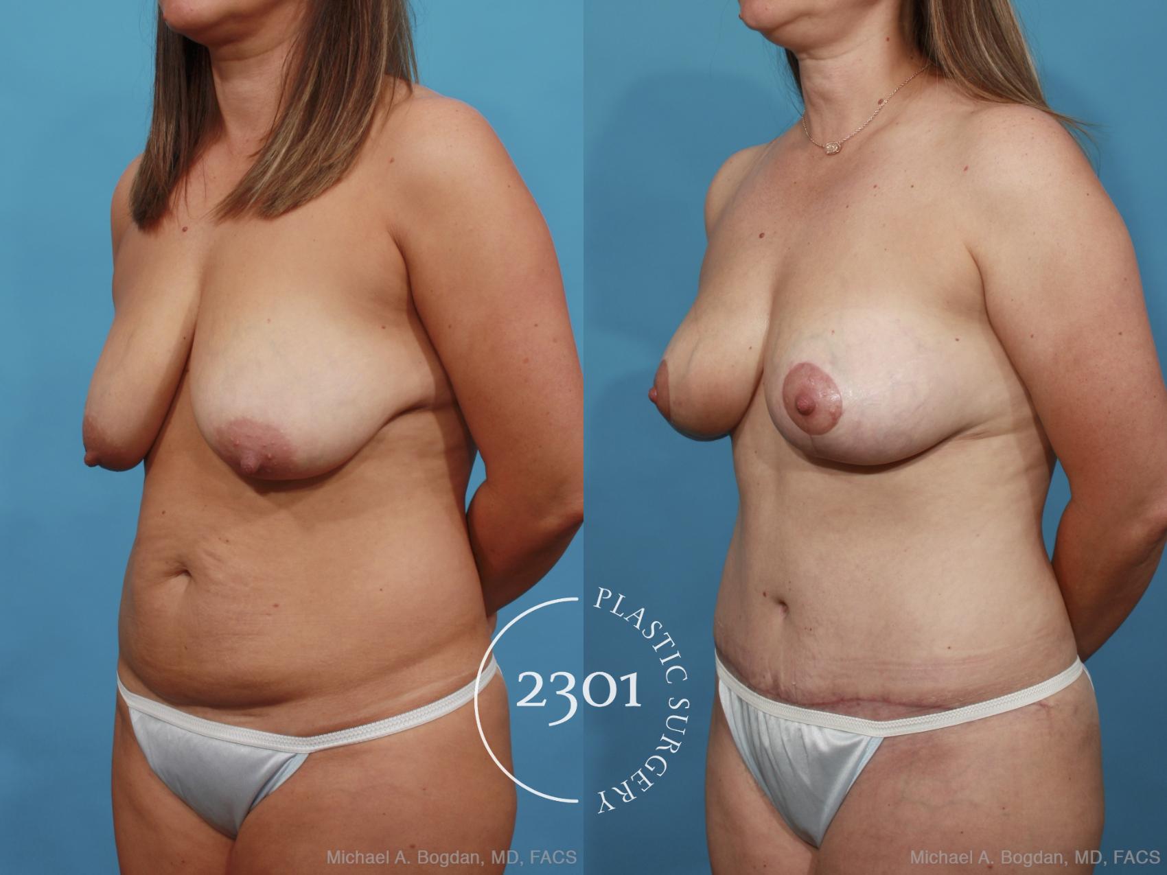 Before & After Mommy Makeover Case 454 View #2 View in Fort Worth, Plano, & Frisco, Texas
