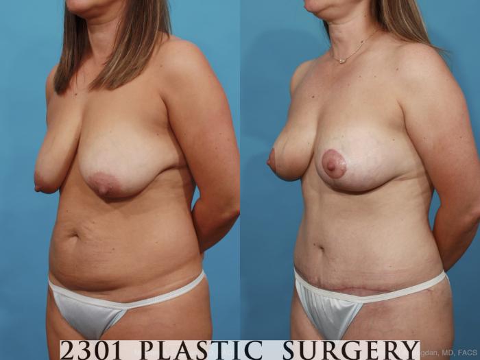 Before & After Mommy Makeover Case 454 View #2 View in Fort Worth, Plano, & Frisco, Texas