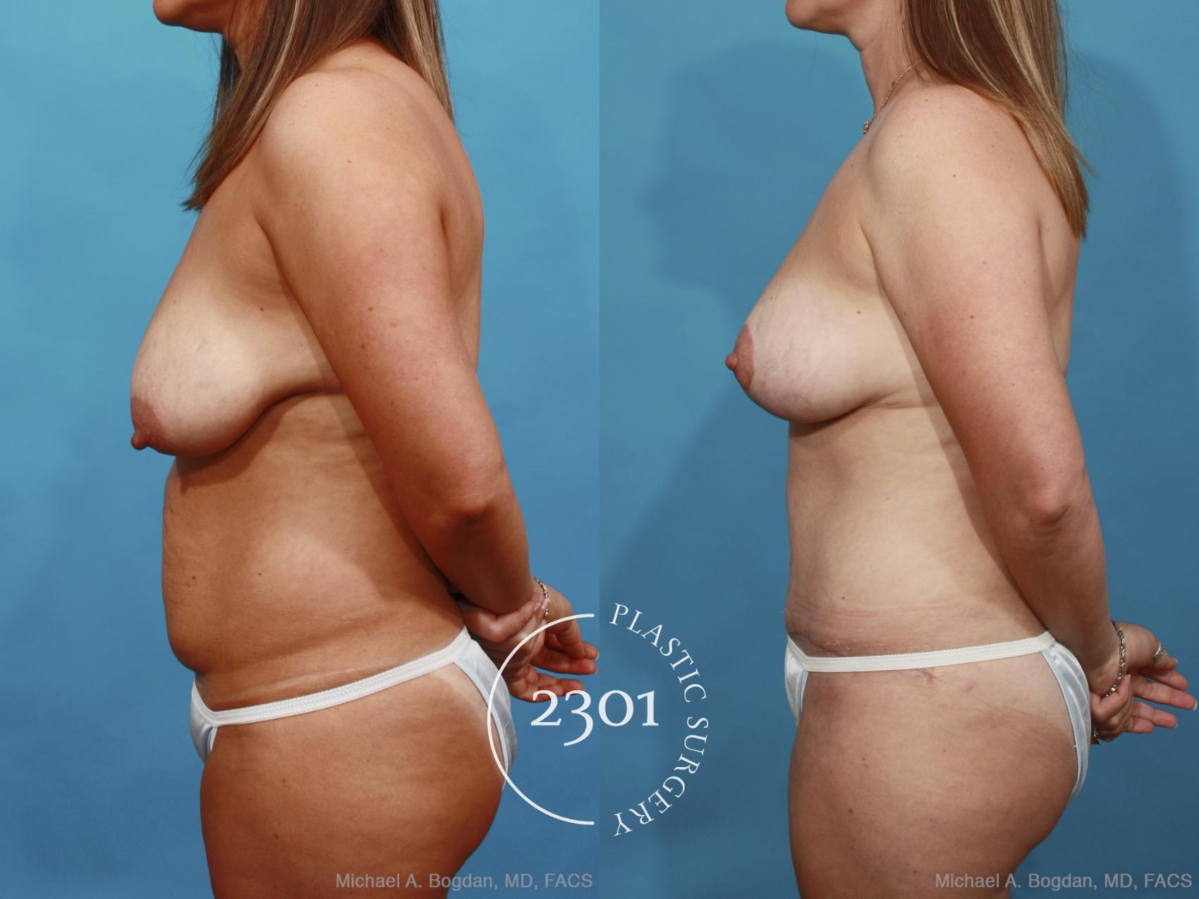 Before & After Mommy Makeover Case 454 View #3 View in Fort Worth, Plano, & Frisco, Texas