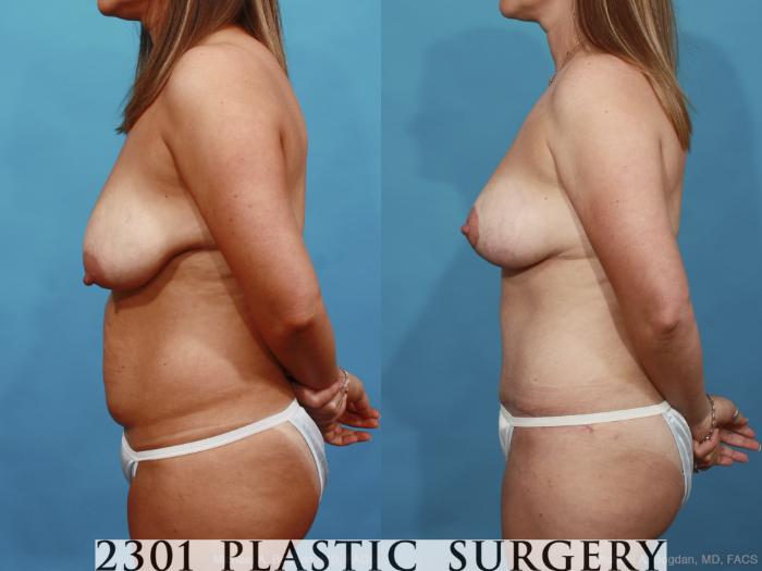 Before & After Mommy Makeover Case 454 View #3 View in Fort Worth, Plano, & Frisco, Texas