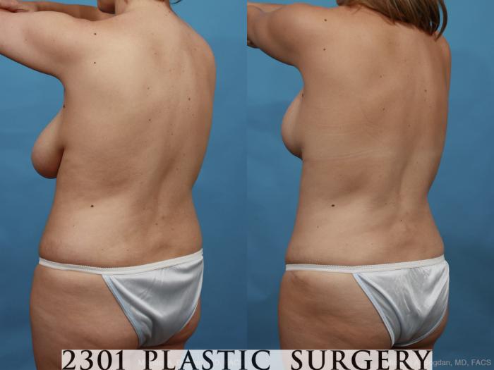 Before & After Mommy Makeover Case 459 View #4 View in Fort Worth, Plano, & Frisco, Texas
