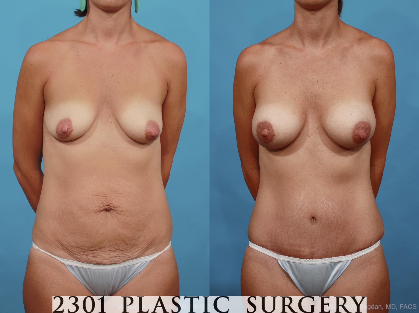Before & After Breast Augmentation Case 461 View #1 View in Fort Worth, Plano, & Frisco, Texas