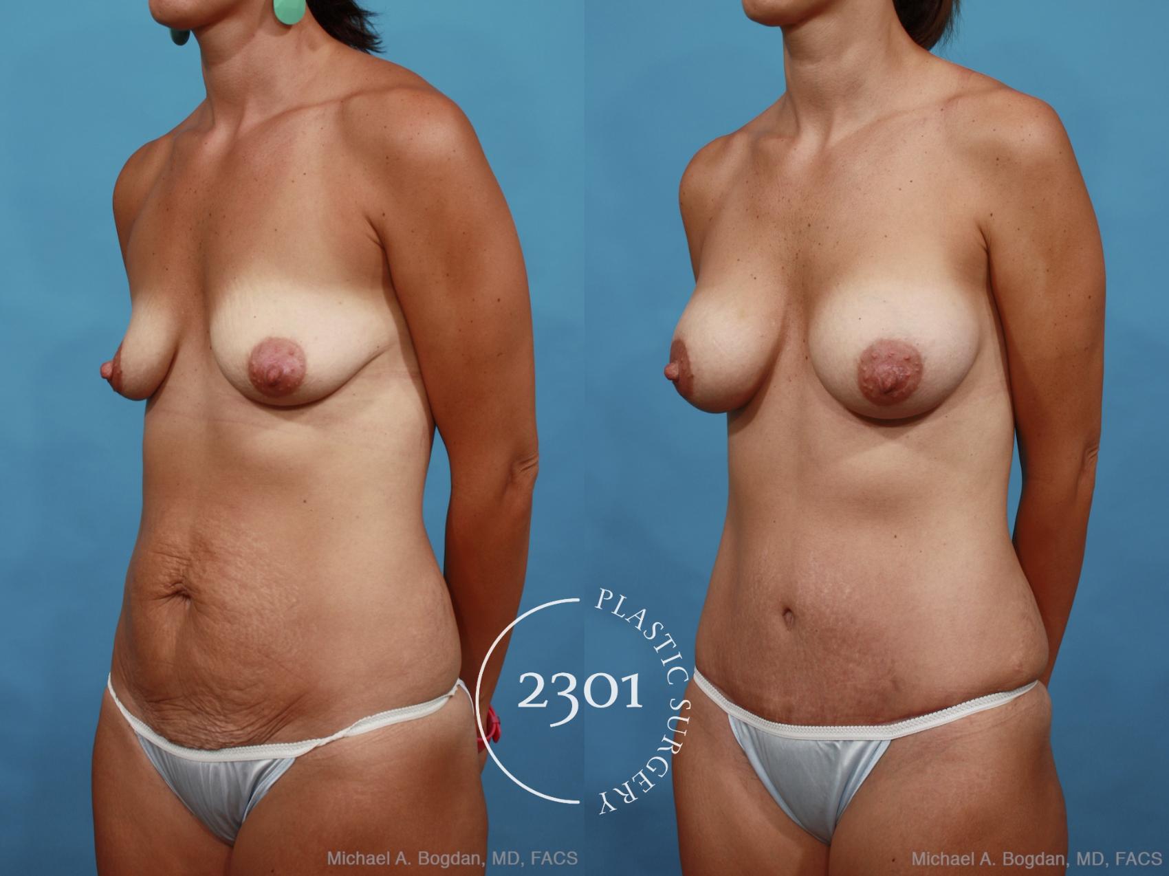 Before & After Silicone Implants Case 461 View #2 View in Fort Worth, Plano, & Frisco, Texas