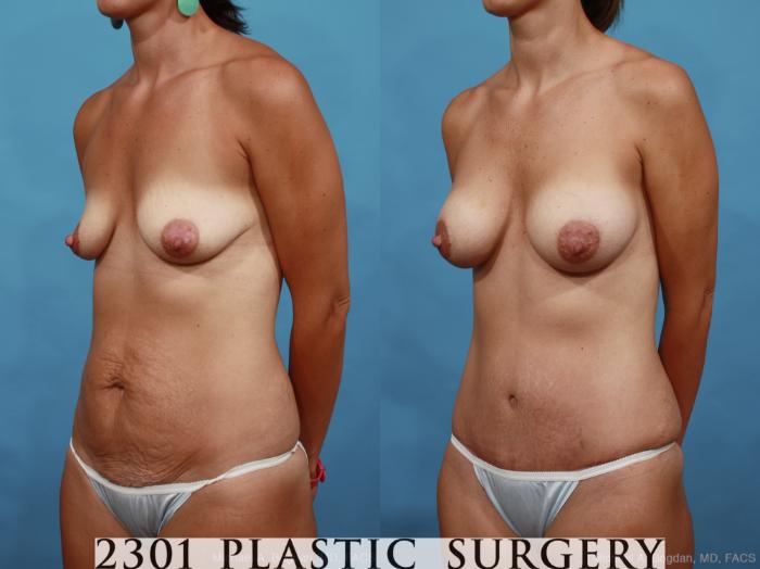 Before & After Silicone Implants Case 461 View #2 View in Fort Worth, Plano, & Frisco, Texas