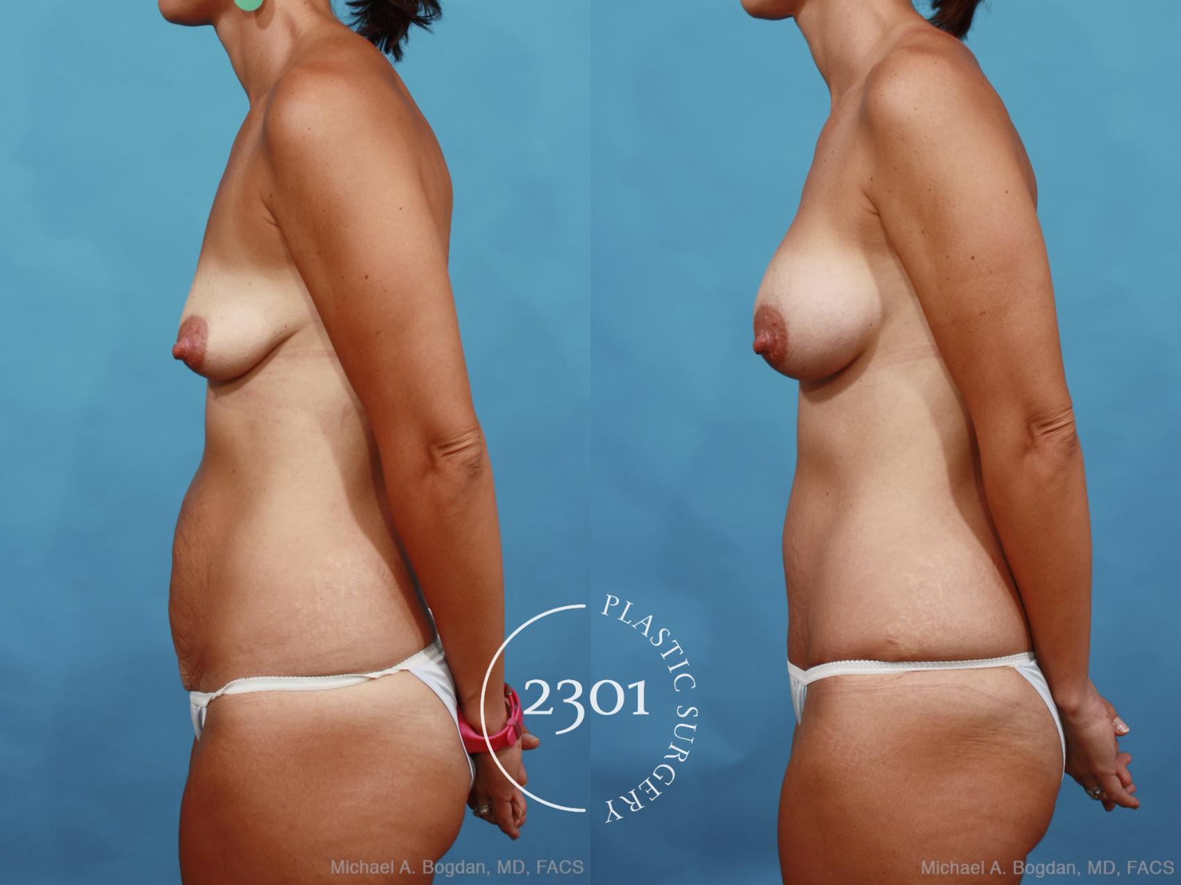 Before & After Silicone Implants Case 461 View #3 View in Fort Worth, Plano, & Frisco, Texas