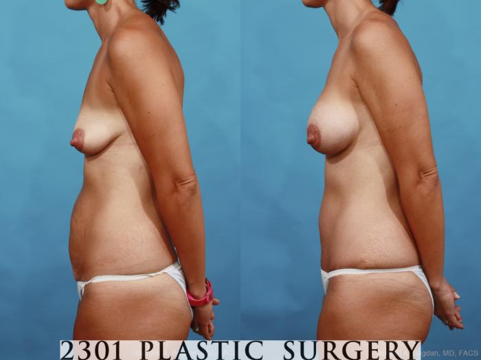 Before & After Silicone Implants Case 461 View #3 View in Fort Worth, Plano, & Frisco, Texas