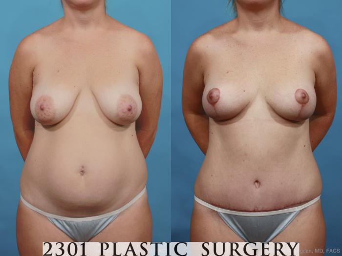 Before & After Breast Lift (Mastopexy) Case 462 View #1 View in Fort Worth, Plano, & Frisco, Texas