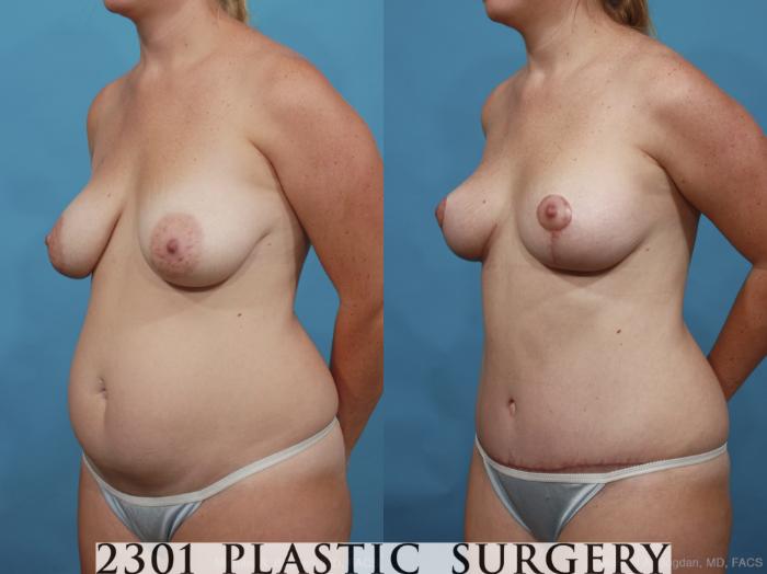 Before & After Breast Lift (Mastopexy) Case 462 View #2 View in Fort Worth, Plano, & Frisco, Texas