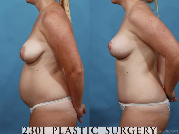 Before & After Mommy Makeover Case 462 View #3 View in Fort Worth, Plano, & Frisco, Texas