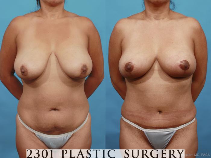 Before & After Breast Lift (Mastopexy) Case 463 View #1 View in Fort Worth, Plano, & Frisco, Texas
