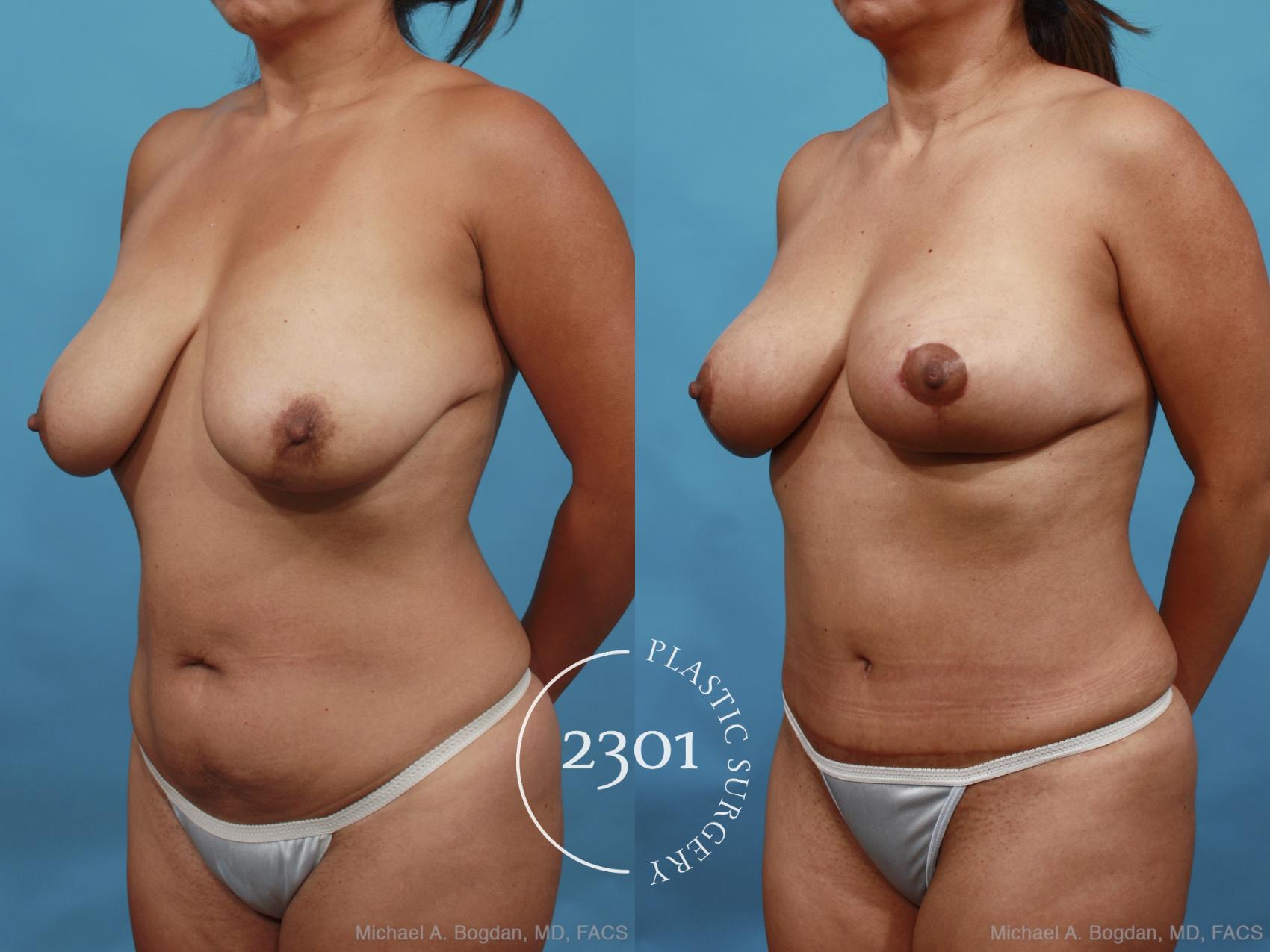 Before & After Mommy Makeover Case 463 View #2 View in Fort Worth, Plano, & Frisco, Texas