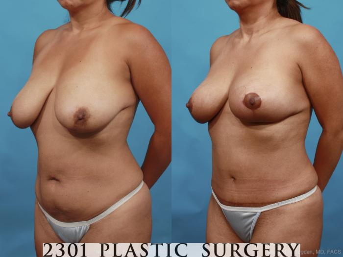 Before & After Breast Lift (Mastopexy) Case 463 View #2 View in Fort Worth, Plano, & Frisco, Texas