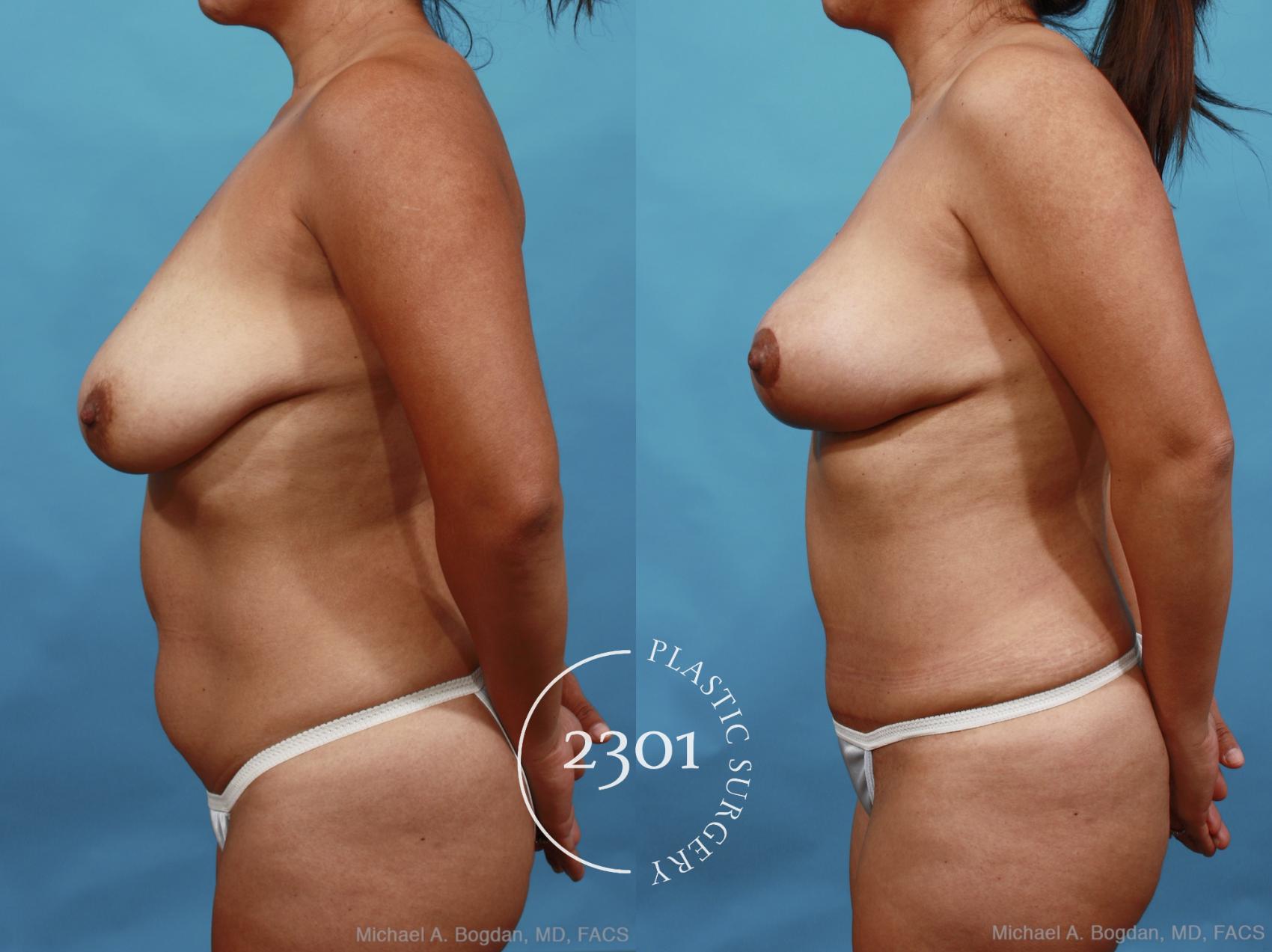 Before & After Mommy Makeover Case 463 View #3 View in Fort Worth, Plano, & Frisco, Texas
