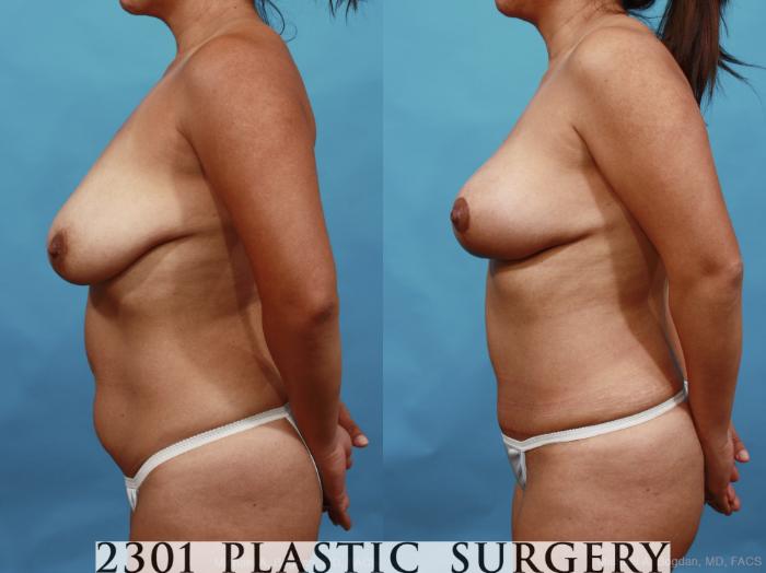 Before & After Breast Lift (Mastopexy) Case 463 View #3 View in Fort Worth, Plano, & Frisco, Texas