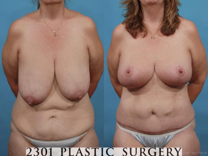 Before & After Post-Bariatric Plastic Surgery Case 464 View #1 View in Fort Worth, Plano, & Frisco, Texas