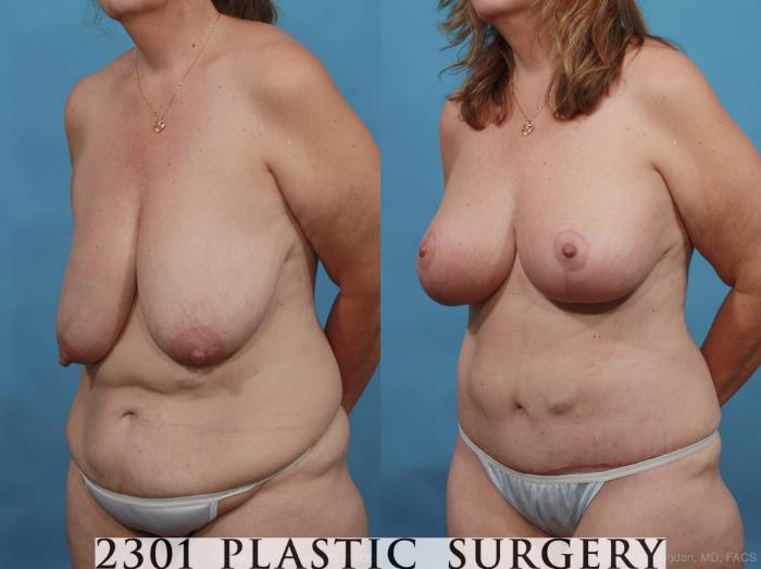 Before & After Breast Lift (Mastopexy) Case 464 View #2 View in Fort Worth, Plano, & Frisco, Texas