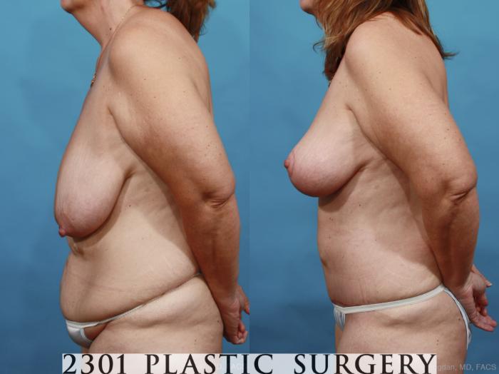 Before & After Post-Bariatric Plastic Surgery Case 464 View #3 View in Fort Worth, Plano, & Frisco, Texas