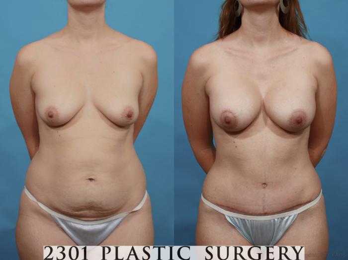 Before & After Silicone Implants Case 468 View #1 View in Fort Worth, Plano, & Frisco, Texas