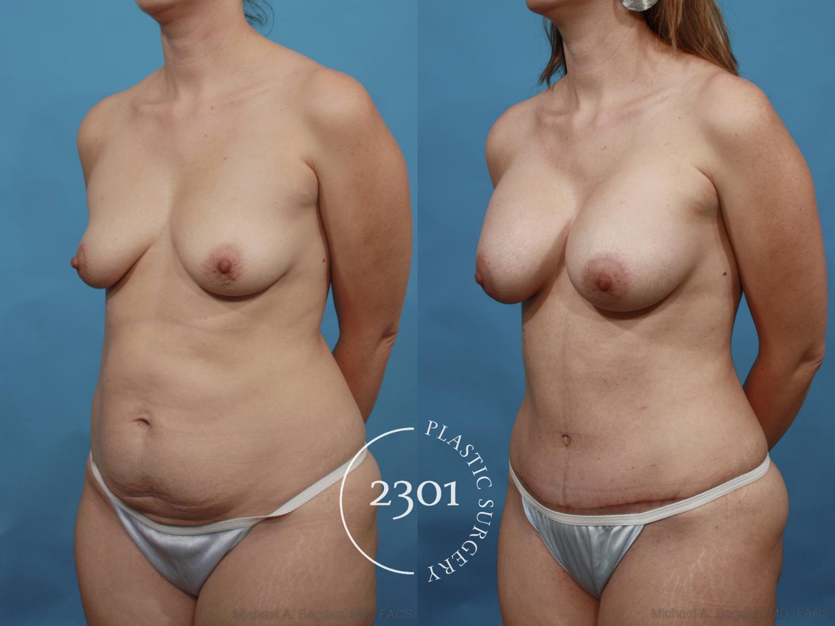 Before & After Mommy Makeover Case 468 View #2 View in Fort Worth, Plano, & Frisco, Texas