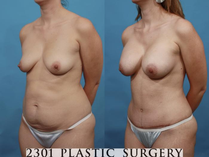 Before & After Breast Augmentation Case 468 View #2 View in Fort Worth, Plano, & Frisco, Texas