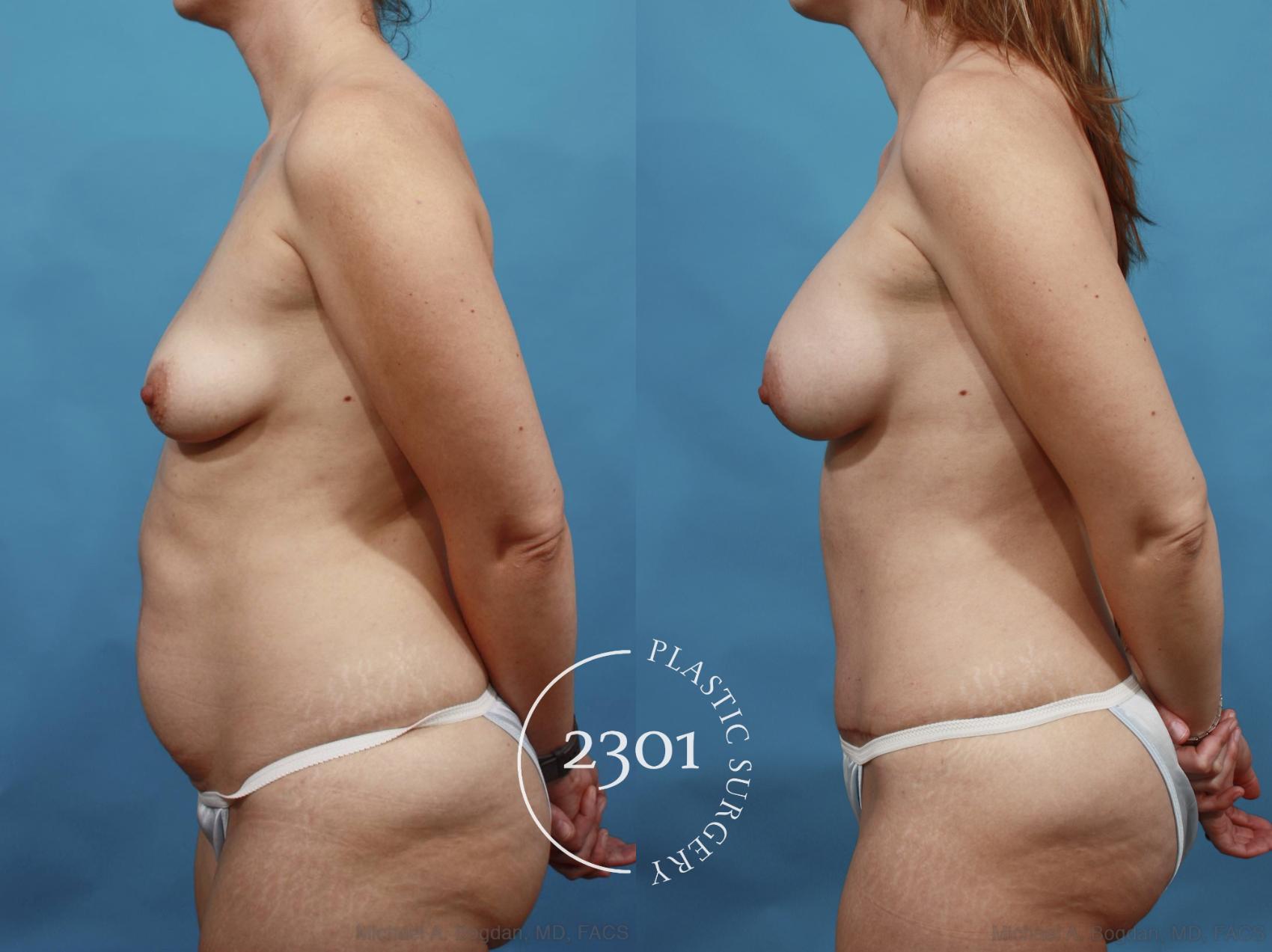Before & After Mommy Makeover Case 468 View #3 View in Fort Worth, Plano, & Frisco, Texas
