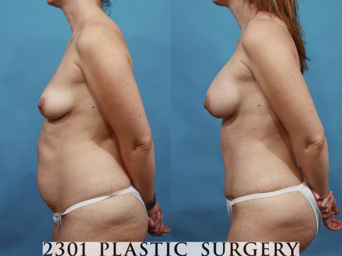 Before & After Breast Augmentation Case 468 View #3 View in Fort Worth, Plano, & Frisco, Texas