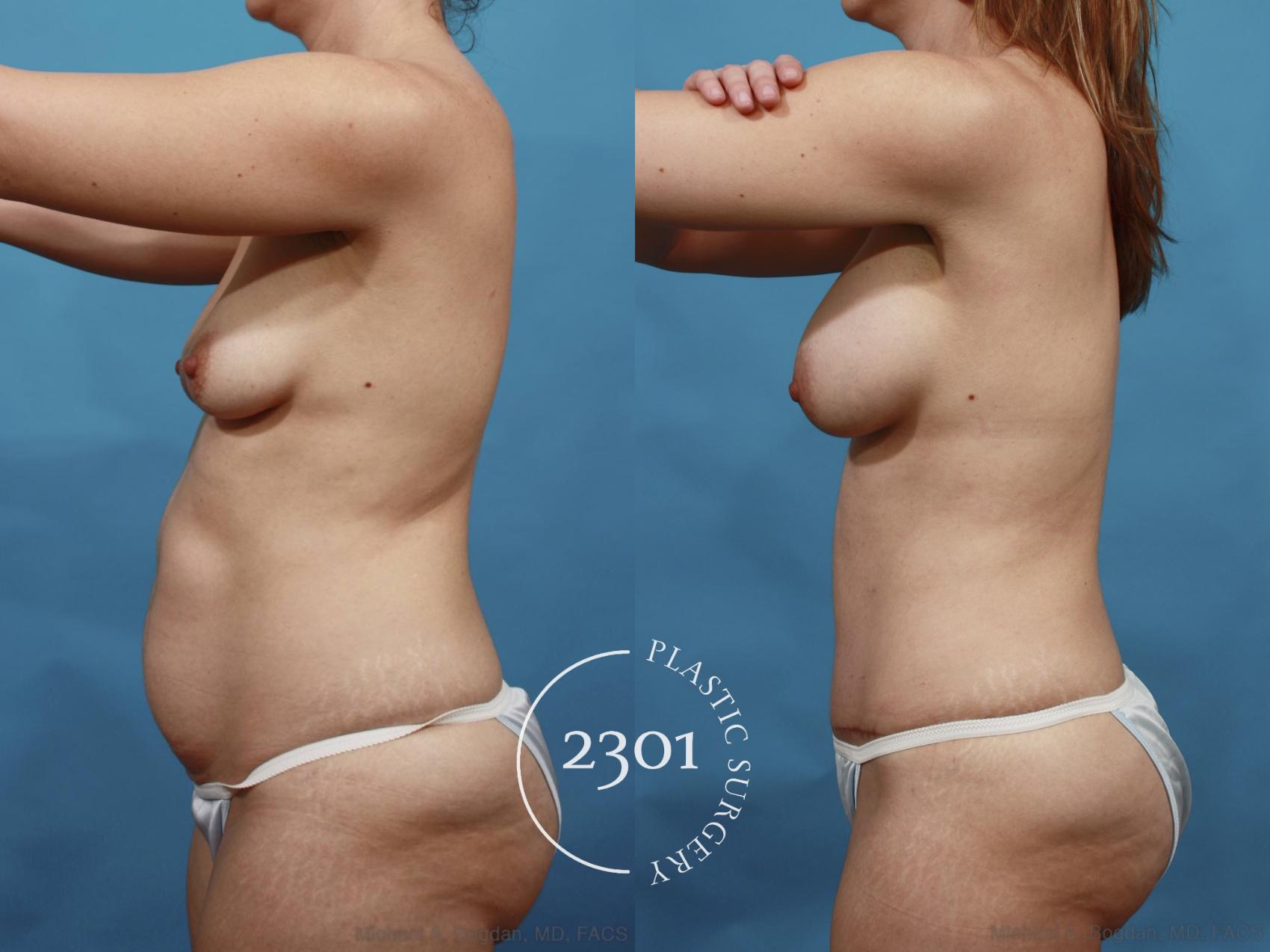 Before & After Mommy Makeover Case 468 View #4 View in Fort Worth, Plano, & Frisco, Texas