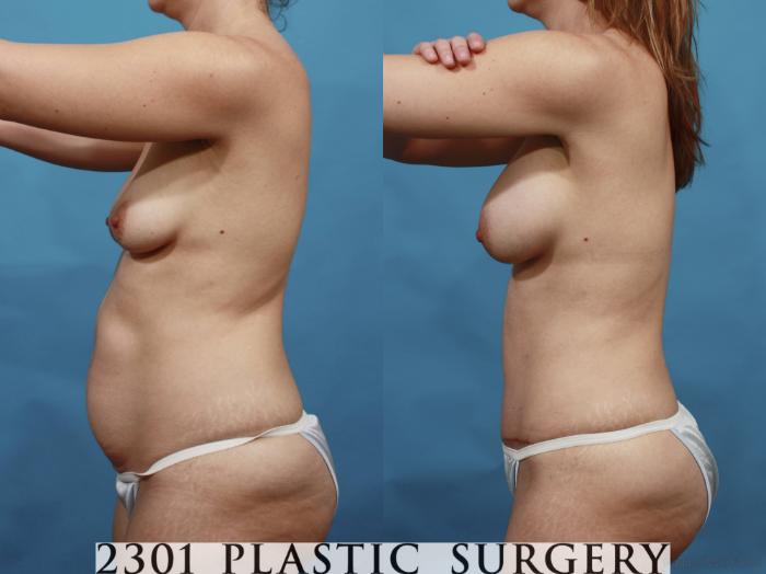 Before & After Breast Augmentation Case 468 View #4 View in Fort Worth, Plano, & Frisco, Texas