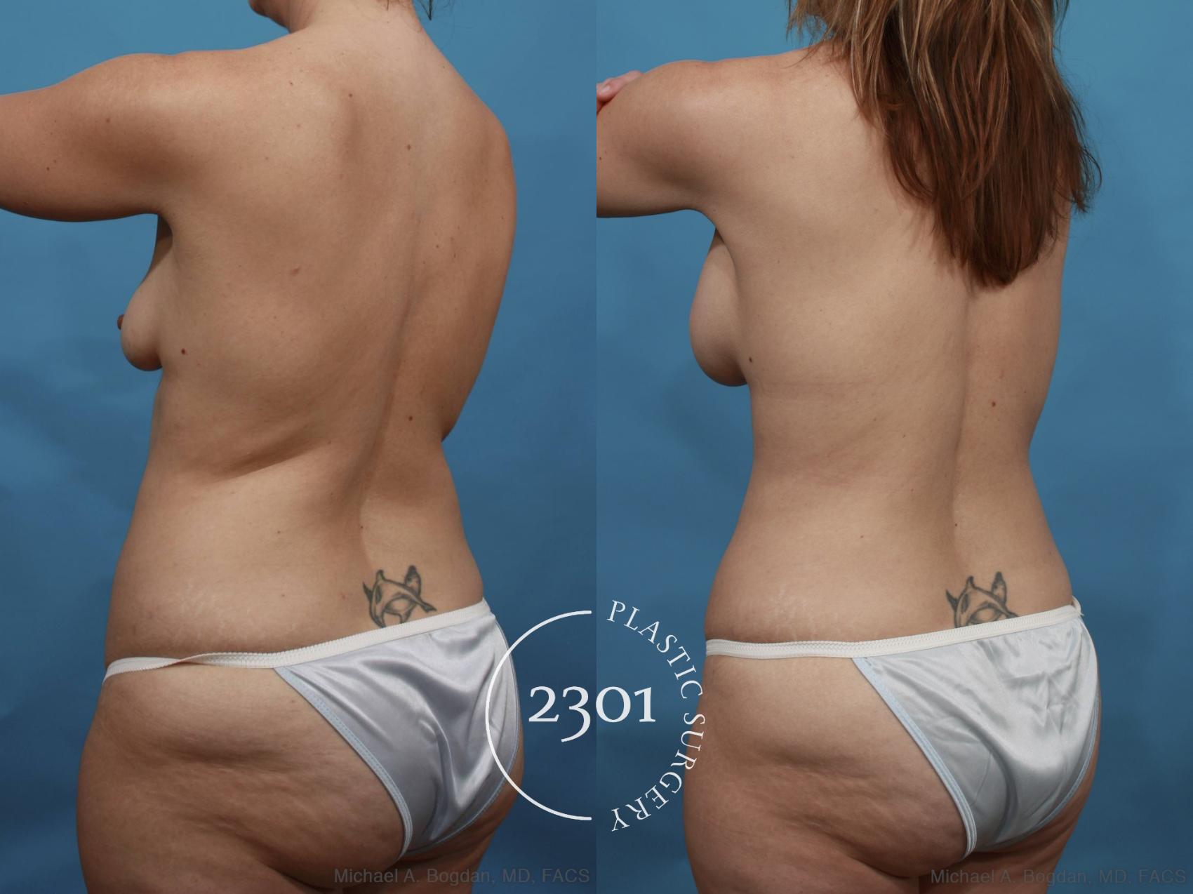 Before & After Mommy Makeover Case 468 View #5 View in Fort Worth, Plano, & Frisco, Texas