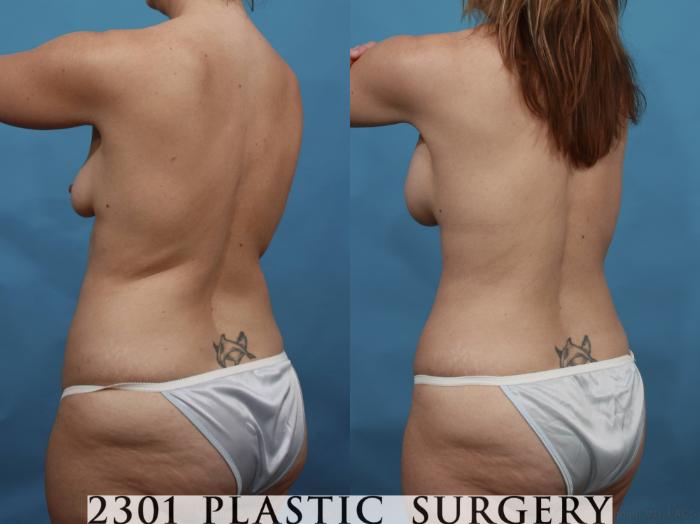 Before & After Silicone Implants Case 468 View #5 View in Fort Worth, Plano, & Frisco, Texas