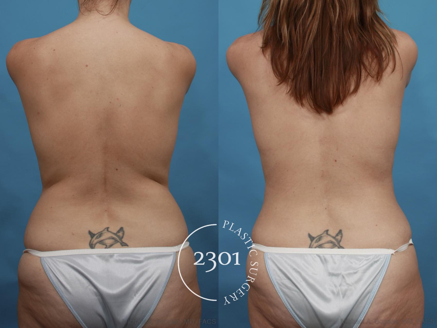 Before & After Mommy Makeover Case 468 View #6 View in Fort Worth, Plano, & Frisco, Texas
