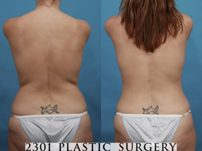 Before & After Silicone Implants Case 468 View #6 View in Fort Worth, Plano, & Frisco, Texas
