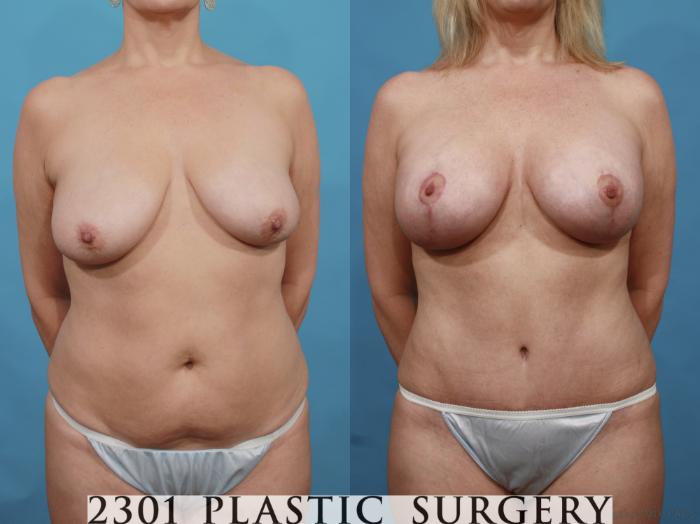 Before & After Mastopexy & Augmentation Case 499 View #1 View in Fort Worth & Frisco, Texas