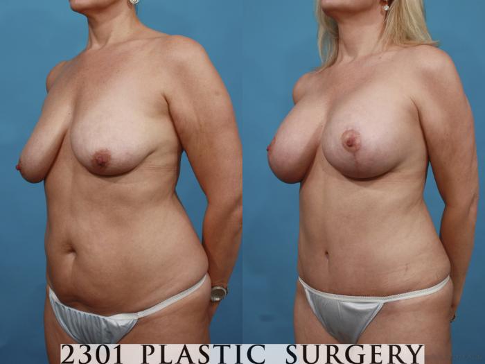 Before & After Mastopexy & Augmentation Case 499 View #2 View in Fort Worth, Plano, & Frisco, Texas