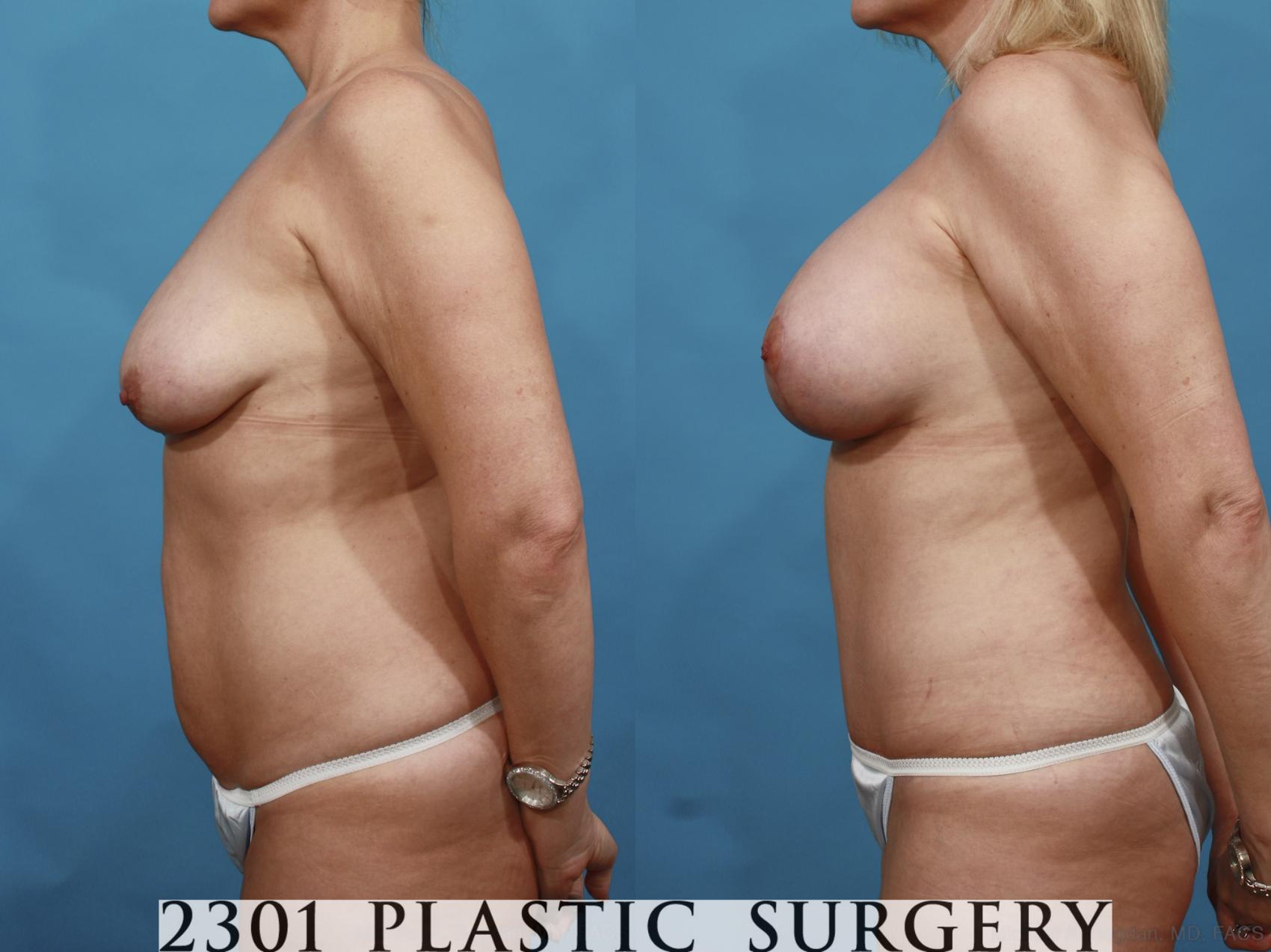 Before & After Silicone Implants Case 499 View #3 View in Fort Worth & Frisco, Texas