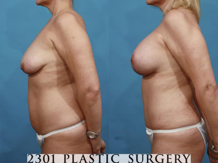 Before & After Mommy Makeover Case 499 View #3 View in Fort Worth, Plano, & Frisco, Texas