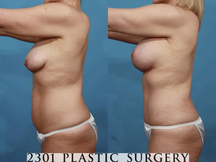 Before & After Mastopexy & Augmentation Case 499 View #4 View in Fort Worth, Plano, & Frisco, Texas