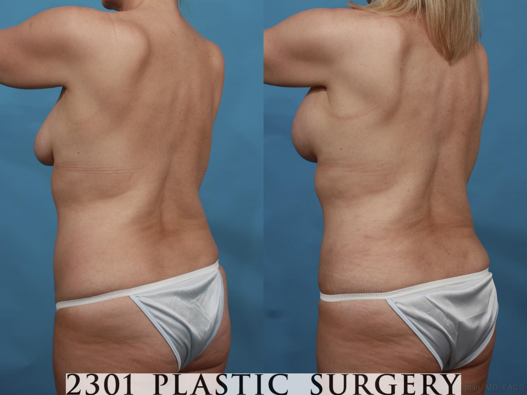 Before & After Silicone Implants Case 499 View #5 View in Fort Worth & Frisco, Texas