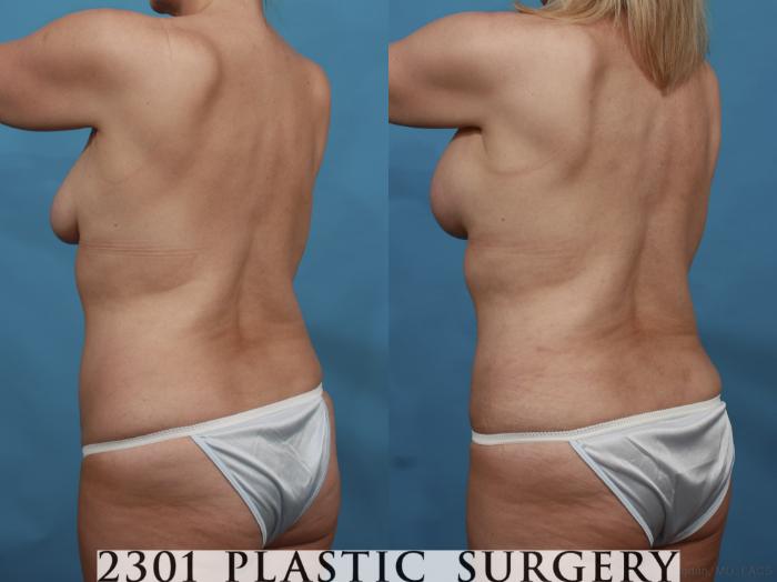 Before & After Tummy Tuck Case 499 View #5 View in Fort Worth, Plano, & Frisco, Texas