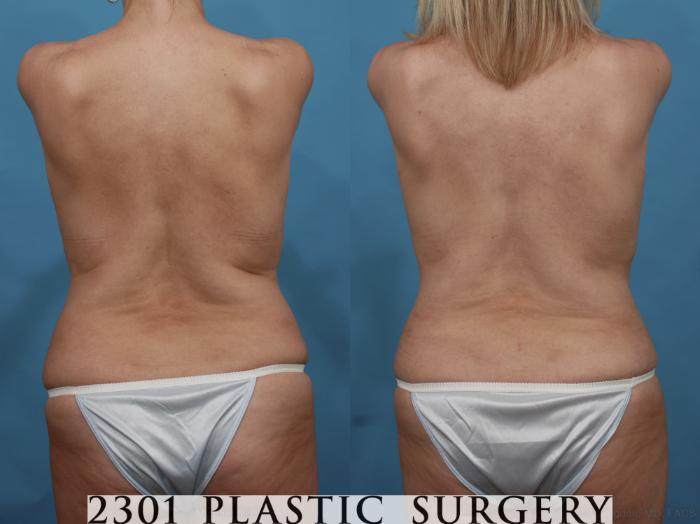 Before & After Silicone Implants Case 499 View #6 View in Fort Worth, Plano, & Frisco, Texas
