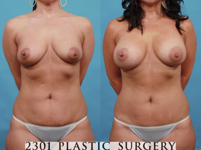 Before & After Tummy Tuck Case 505 View #1 View in Fort Worth, Plano, & Frisco, Texas