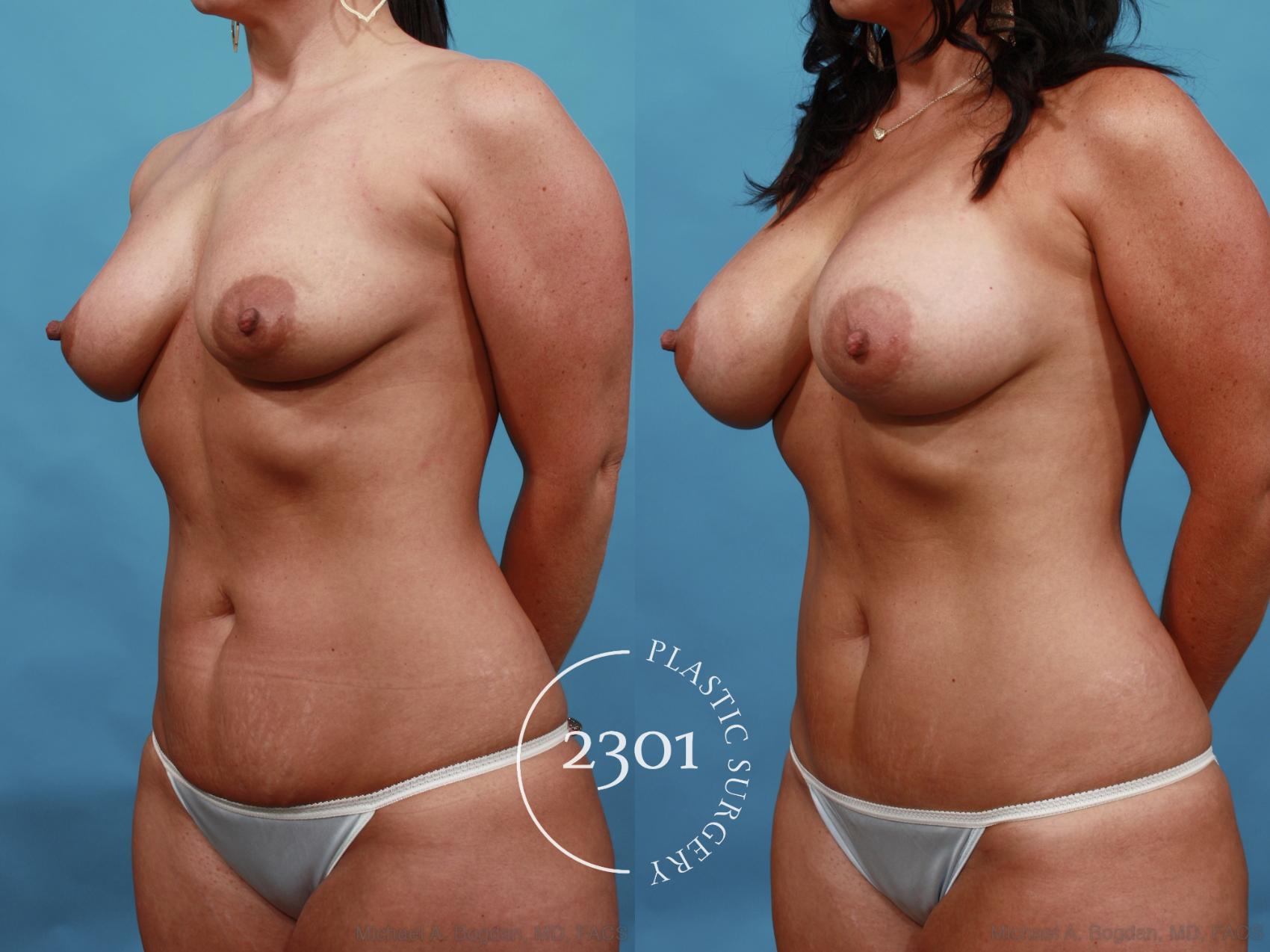 Before & After Tummy Tuck Case 505 View #2 View in Fort Worth, Plano, & Frisco, Texas