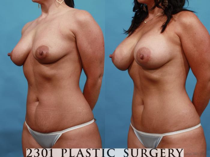Before & After Silicone Implants Case 505 View #2 View in Fort Worth, Plano, & Frisco, Texas